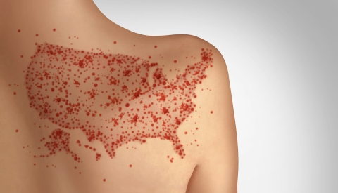 Measles infections send 1 in 5 people to the hospital. wildpixel/ iStock via Getty Images Plus